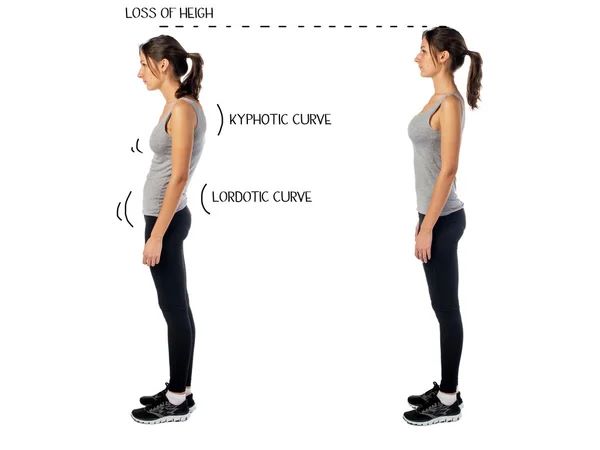 kyphotic and lordotic